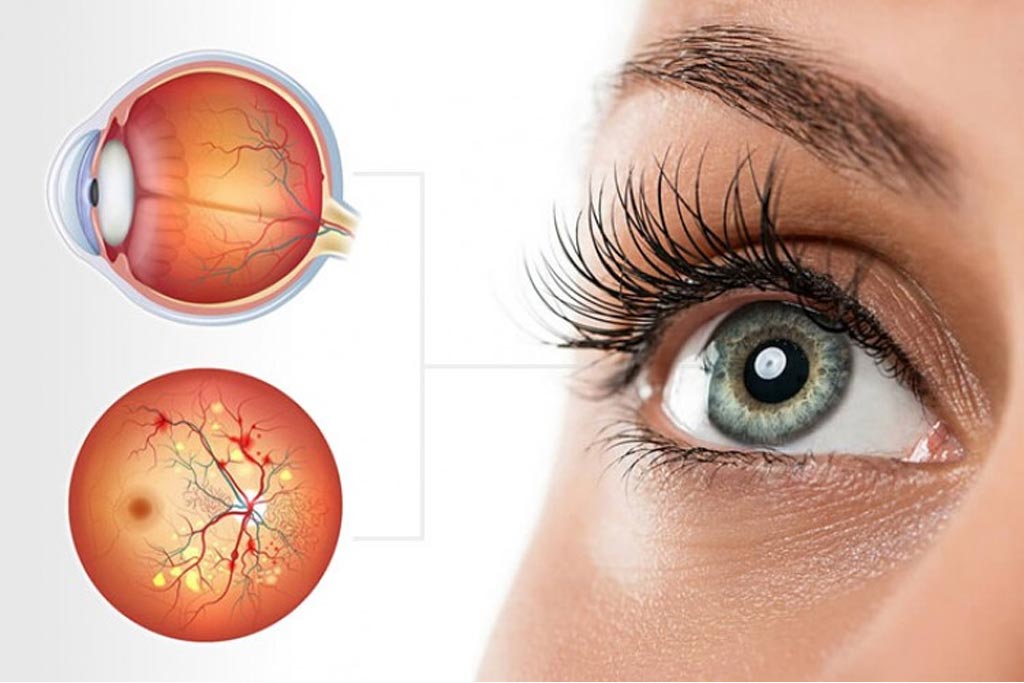 Retina Surgery